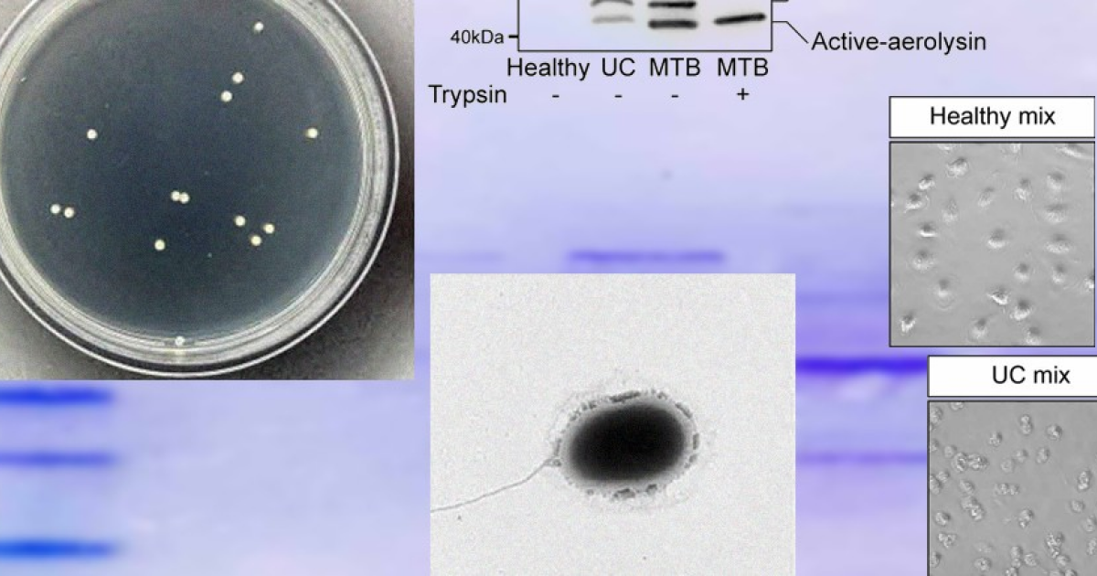 Аэромонады спровоцировали язвенный колит