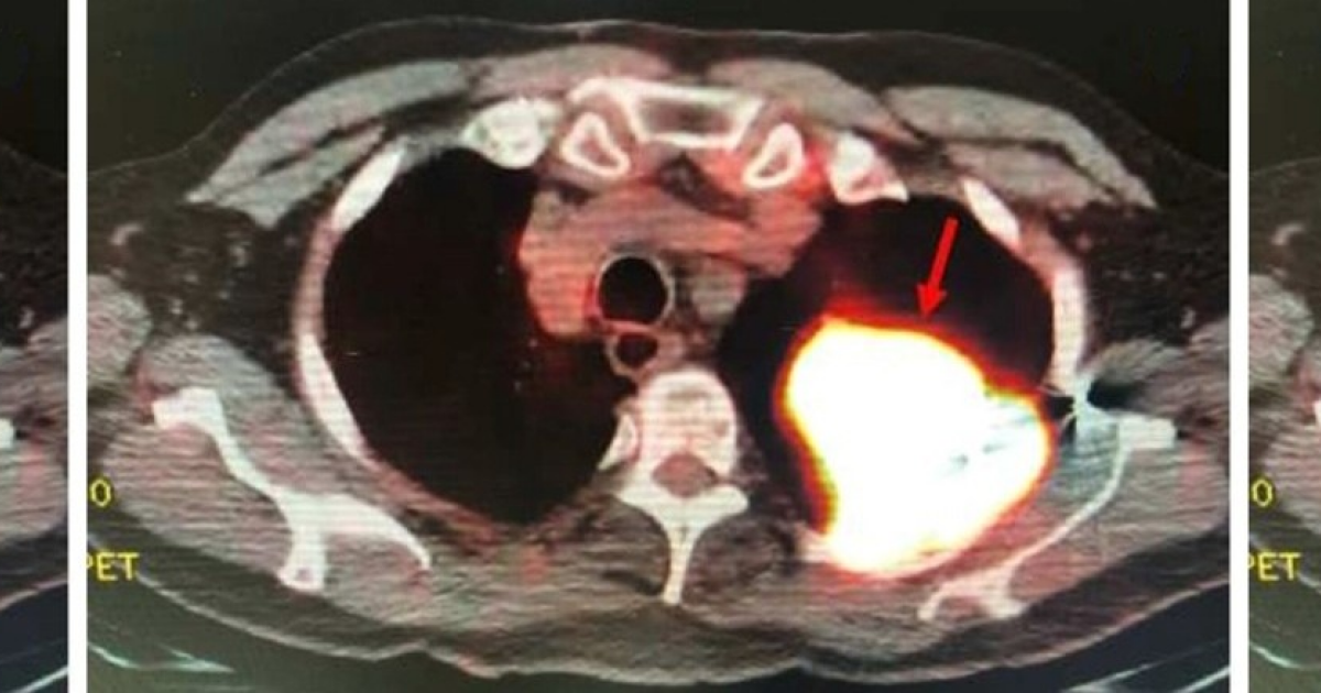 Огнестрельное ранение полувековой давности связали с развитием рака легкого у пожилого американца
