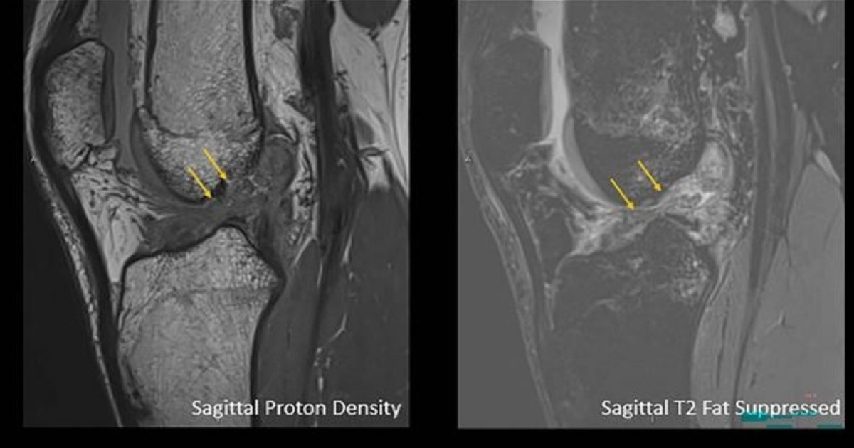 Рентгенологи заметили гендерную разницу в травмах коленей