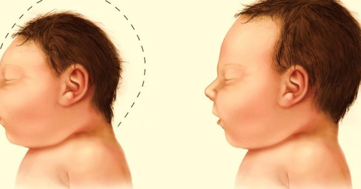 Врожденная вирусная инфекция Зика повысила риск госпитализации из-за эпилепсии у детей