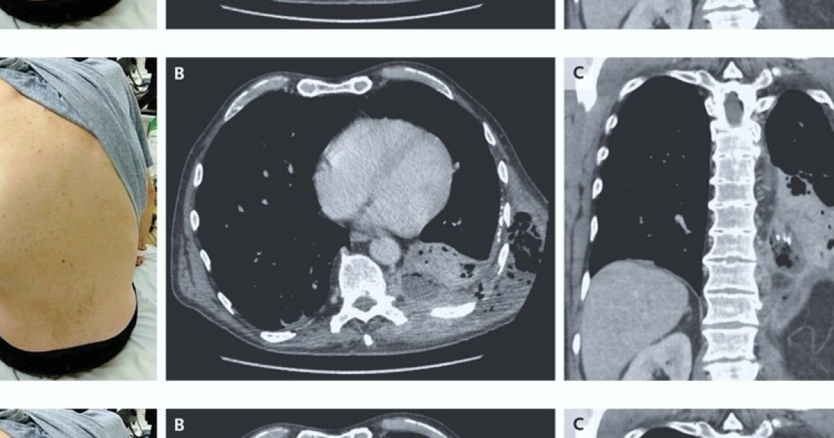 Большая опухоль на спине пожилого американца оказалась скоплением гноя из плевральной полости