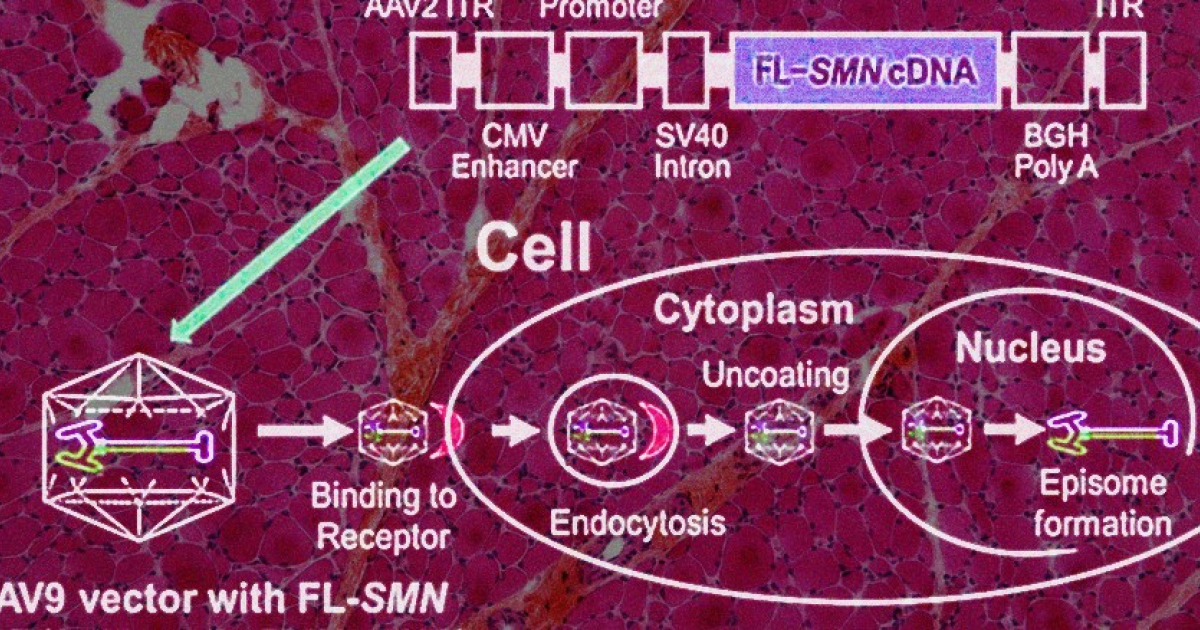 Интратекальная генная терапия помогла детям и подросткам со спинальной мышечной атрофией