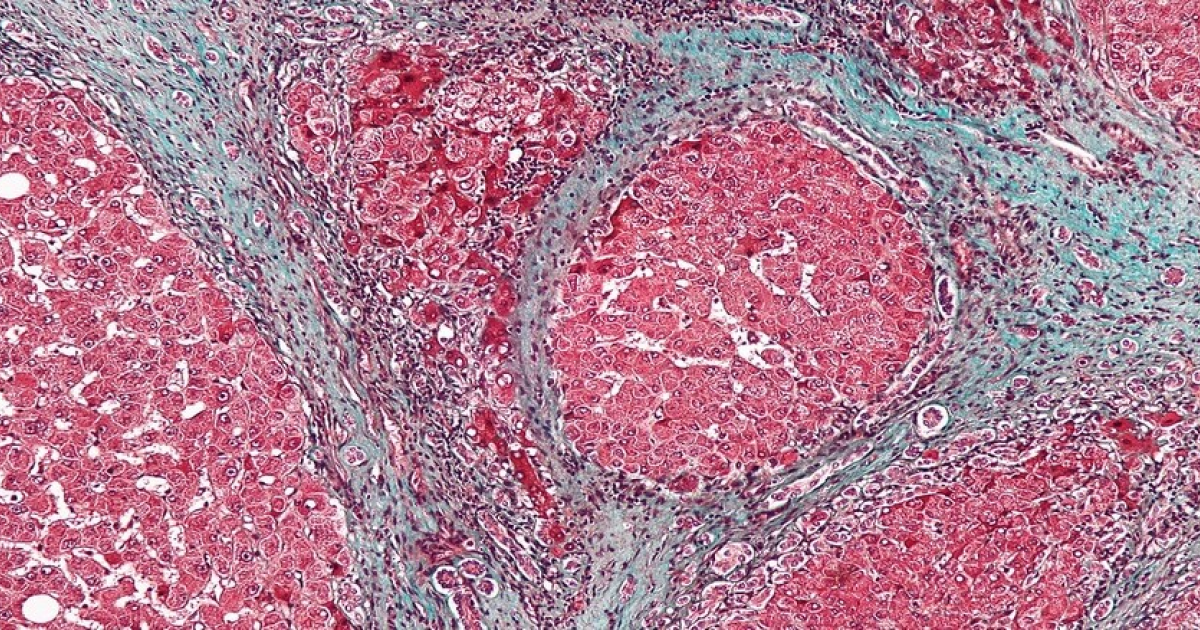 Фибулин-5 в плазме крови показал тяжесть фиброза печени