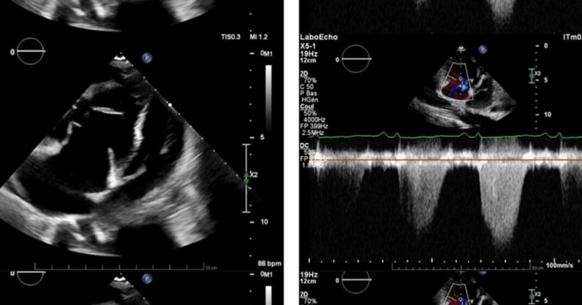 Цинга привела к легочной гипертензии у швейцарки