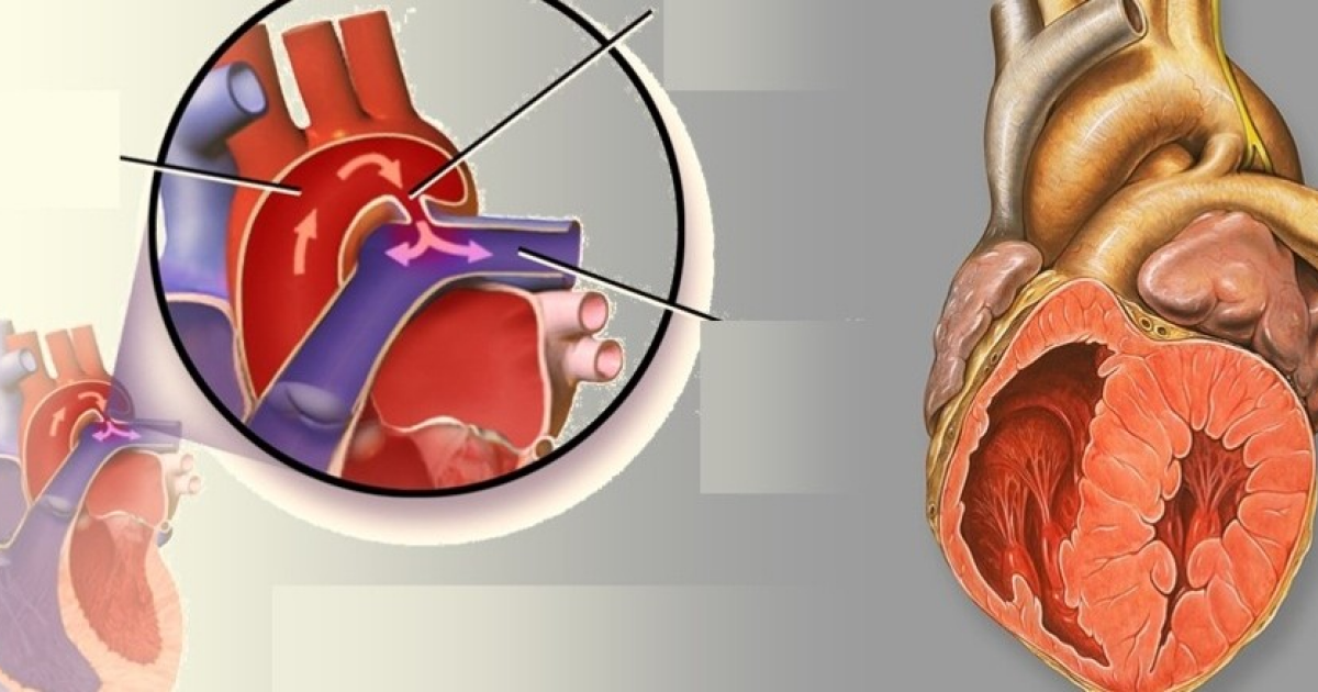 Выжидательная тактика эффективнее лечения снизила риск смерти при открытом артериальном протоке