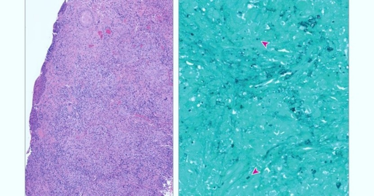 Гистоплазмоз проявился осиплостью голоса и язвой надгортанника