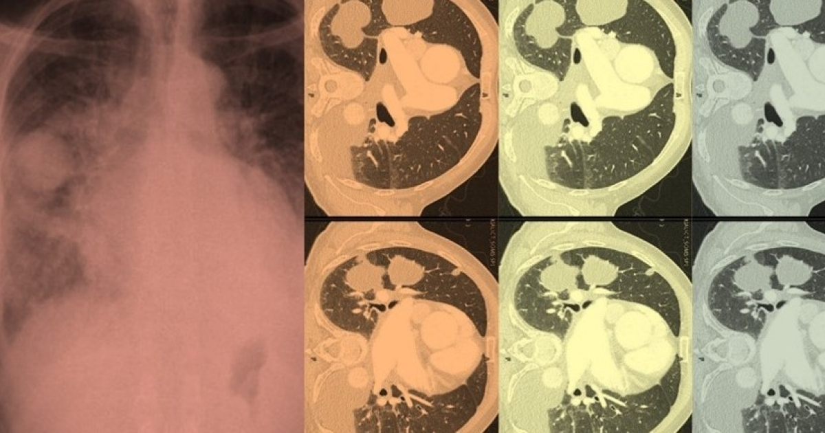 Опухоль в легком у пожилого катарца оказалась отеком из-за сердечной недостаточности