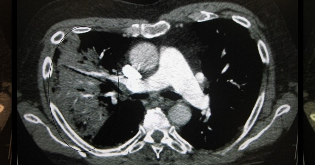 Инфекции нижних дыхательных путей привели к смерти 2,5 миллиона человек в 2023 году
