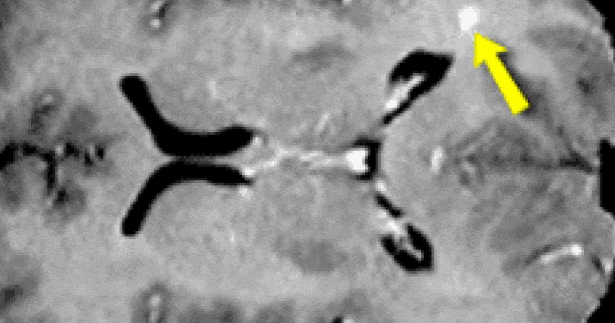 Липоевая кислота не затормозила прогрессирование рассеянного склероза