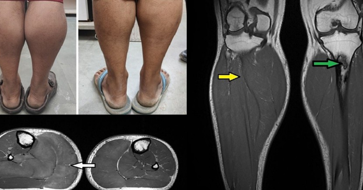 Увеличение мышц голеней у индийца оказалось необычным проявлением гипотиреоза