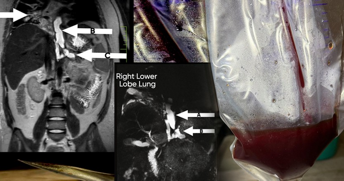 Удар животом о велосипедную ручку привел к свищу между поджелудочной железой и плевральной полостью