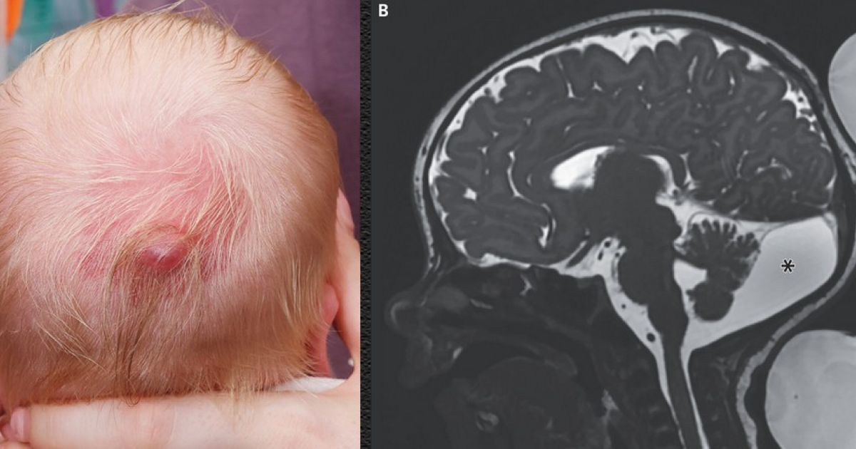 Ирландские врачи вылечили младенца с грыжей мозговых оболочек под кожей головы