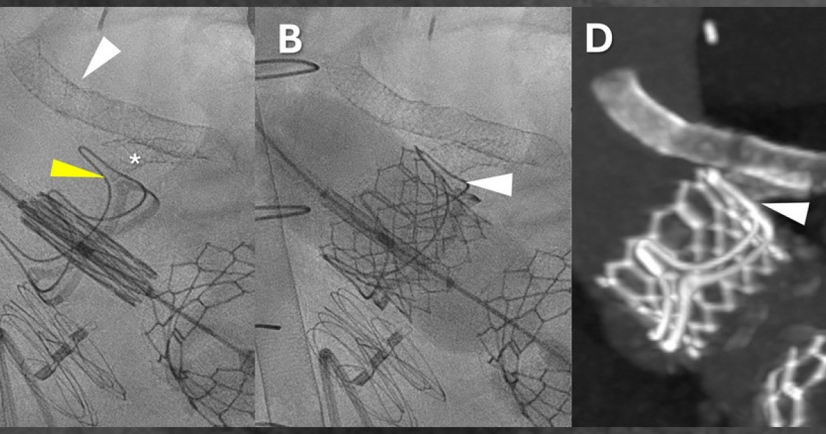 Аортокоронарное шунтирование впервые провели с помощью сосудистых катетеров