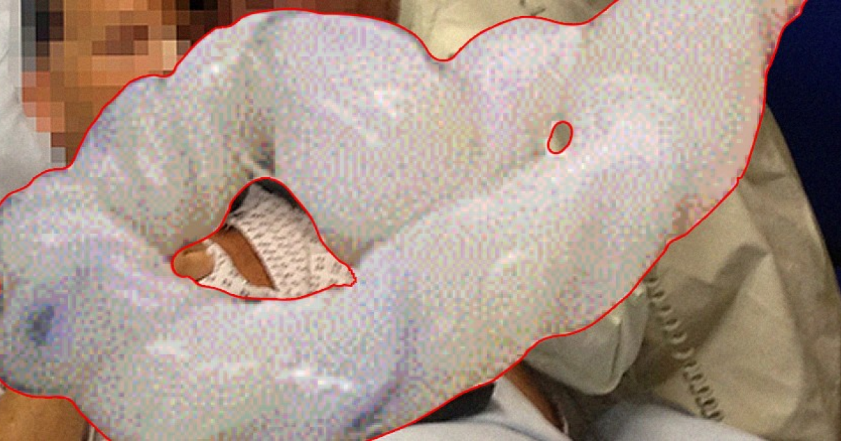 Препарат из пуповинной крови облегчил симптомы постковидного синдрома