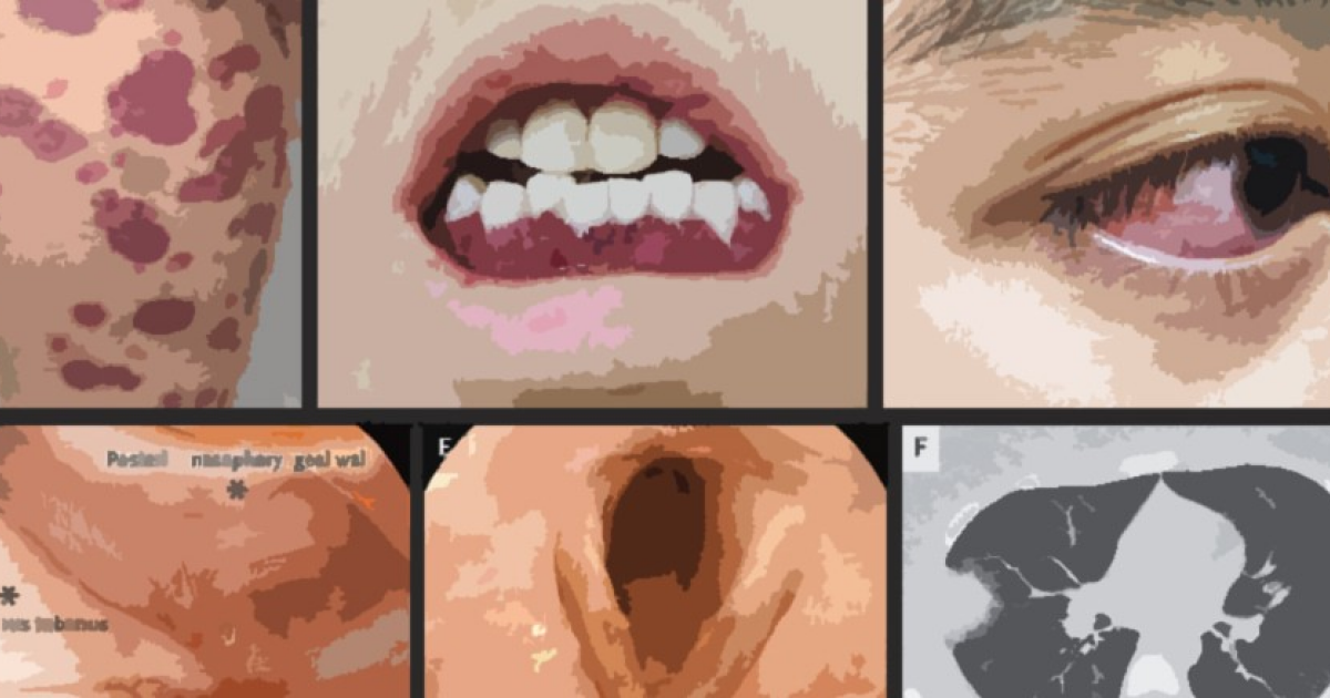 Проблемы с глазом у китаянки обернулись тяжелым аутоиммунным заболеванием