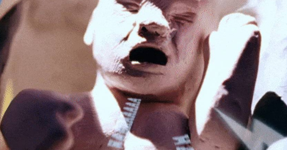 Гестационный диабет у матери повысил риск развития рассеянного склероза у детей