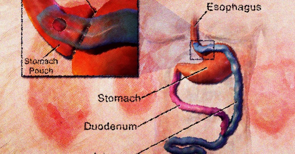 Операции по уменьшению желудка облегчили течение псориаза
