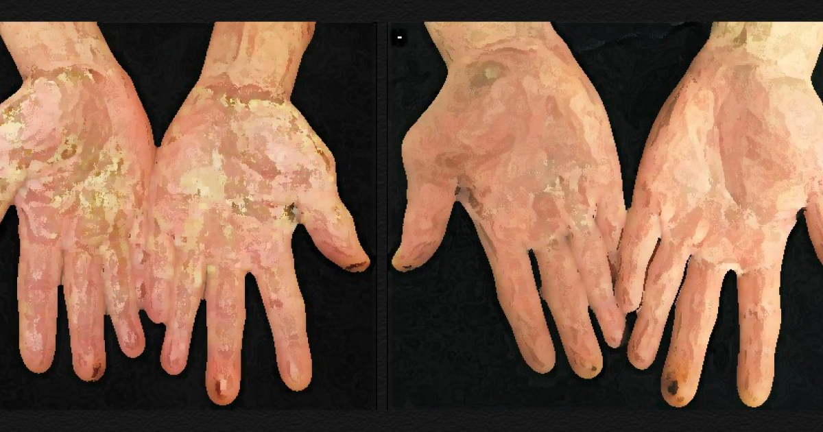 Злостное курение привело к гнойной сыпи на ладонях и стопах американца