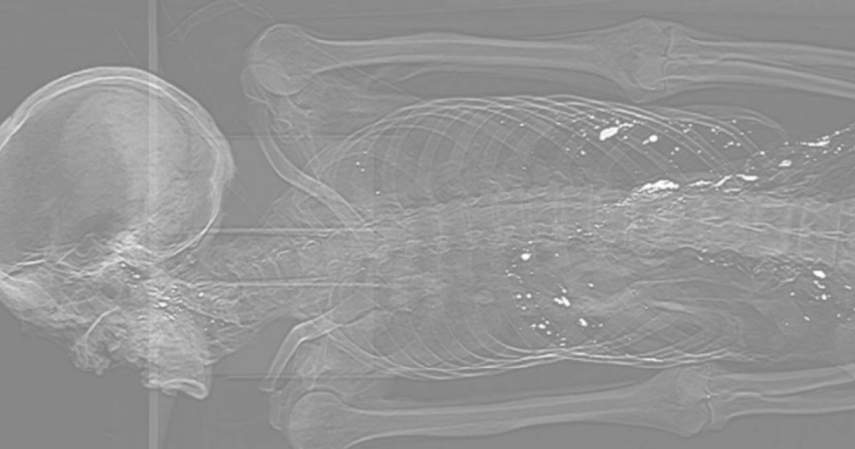 В кишечнике средневековой мумии из Китая обнаружили ртутьсодержащий раствор