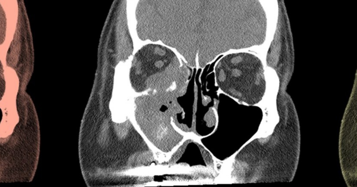 Распространенность грибкового синусита среди людей с иммунодефицитами выросла почти вдвое