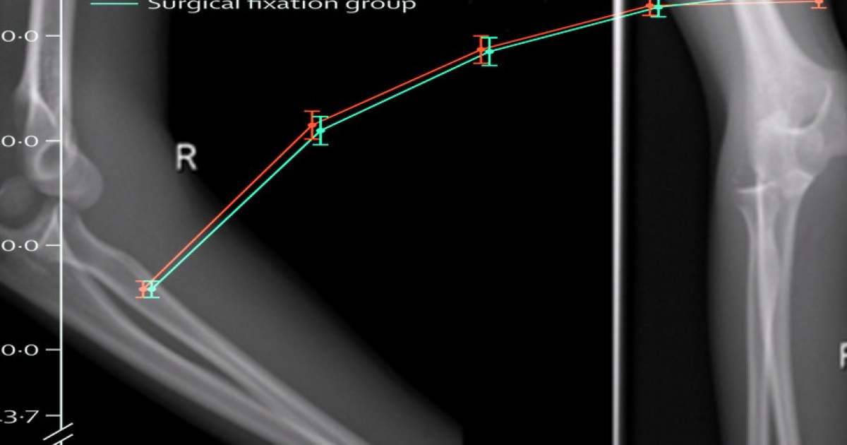 Консервативное лечение превзошло хирургическое при переломах локтя у детей