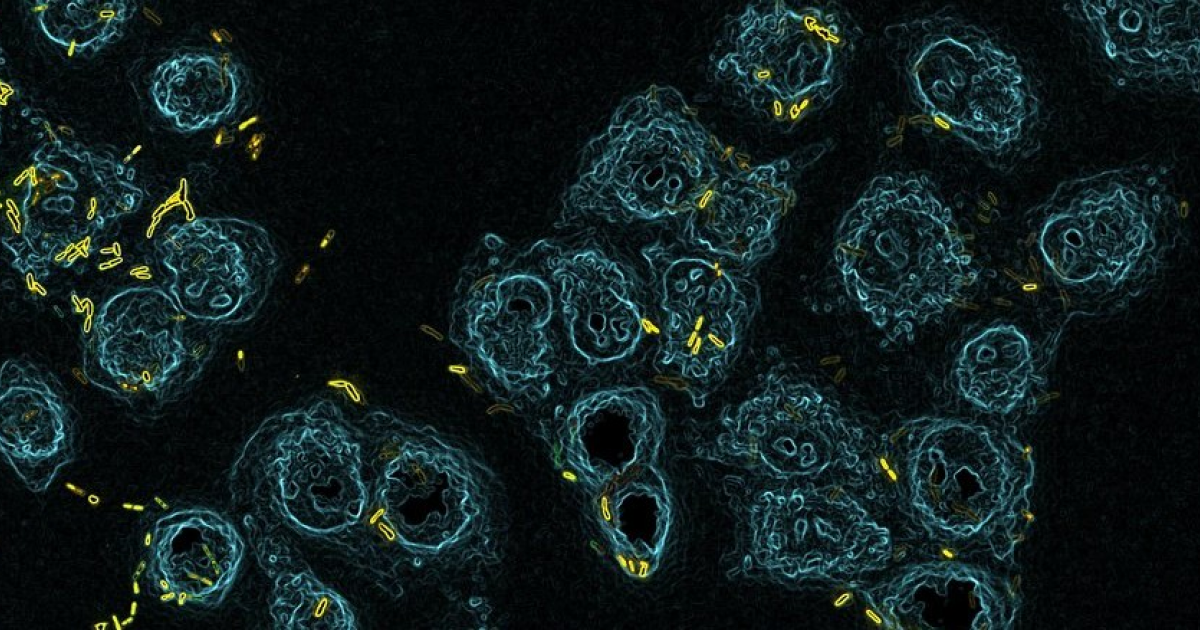 Ингаляции оксида азота помогли при псевдомонадной пневмонии в пилотных испытаниях