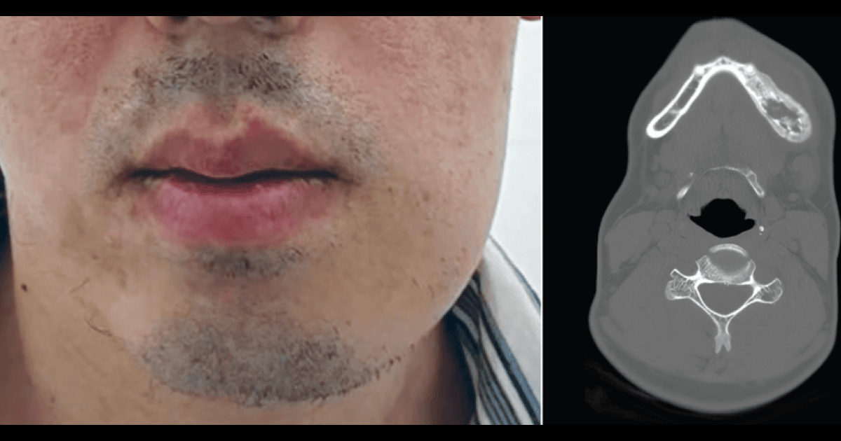 Припухлость нижней челюсти у молодого китайца объяснили синдромом SAPHO