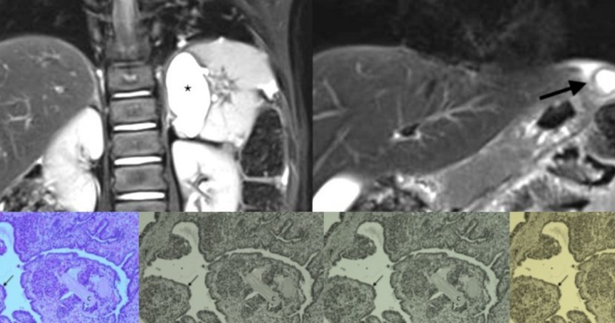 В желудке нерожденной девочки нашли кисту с легочным эпителием
