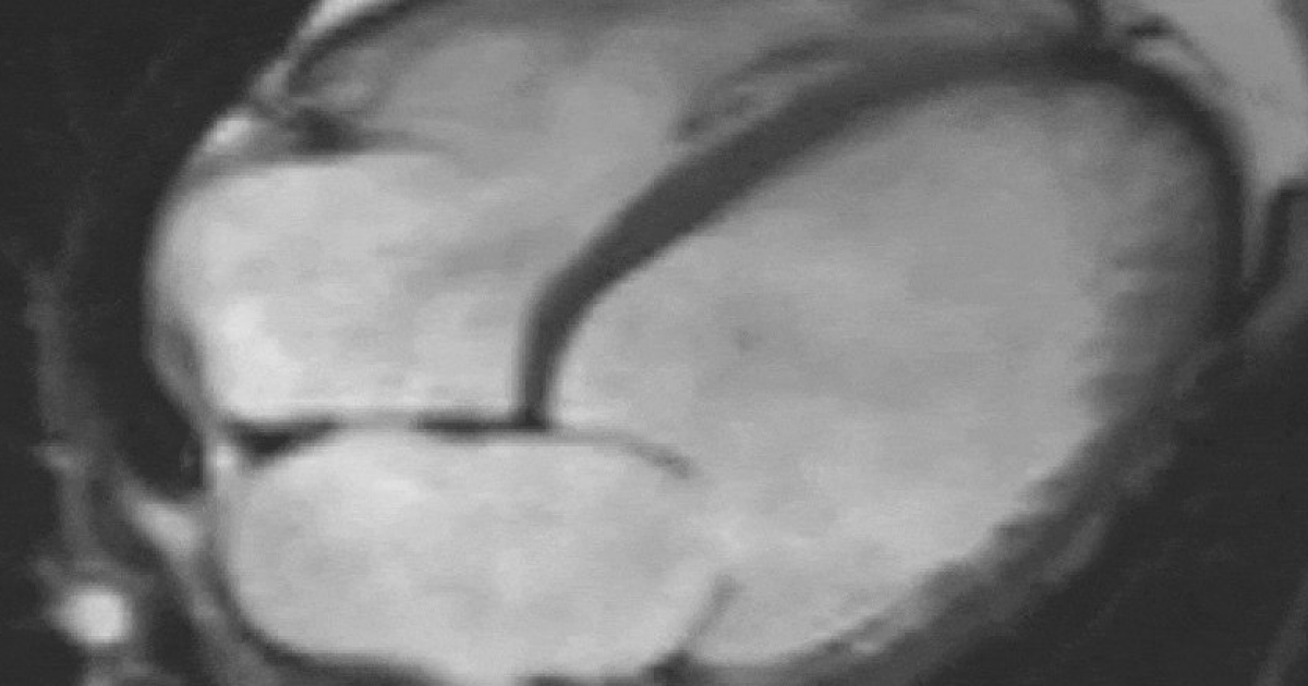 Метаанализ подтвердил неэффективность бета-блокаторов после инфаркта миокарда