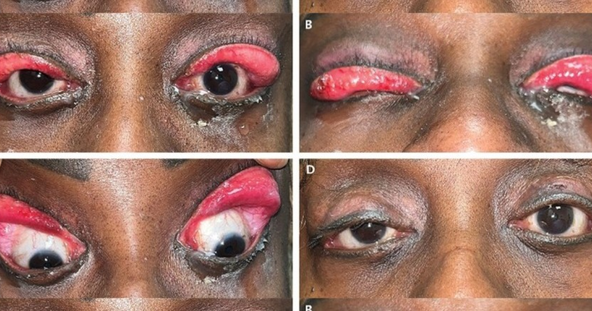 Апноэ во сне привело к синдрому гиперрастяжимых век у молодой американки