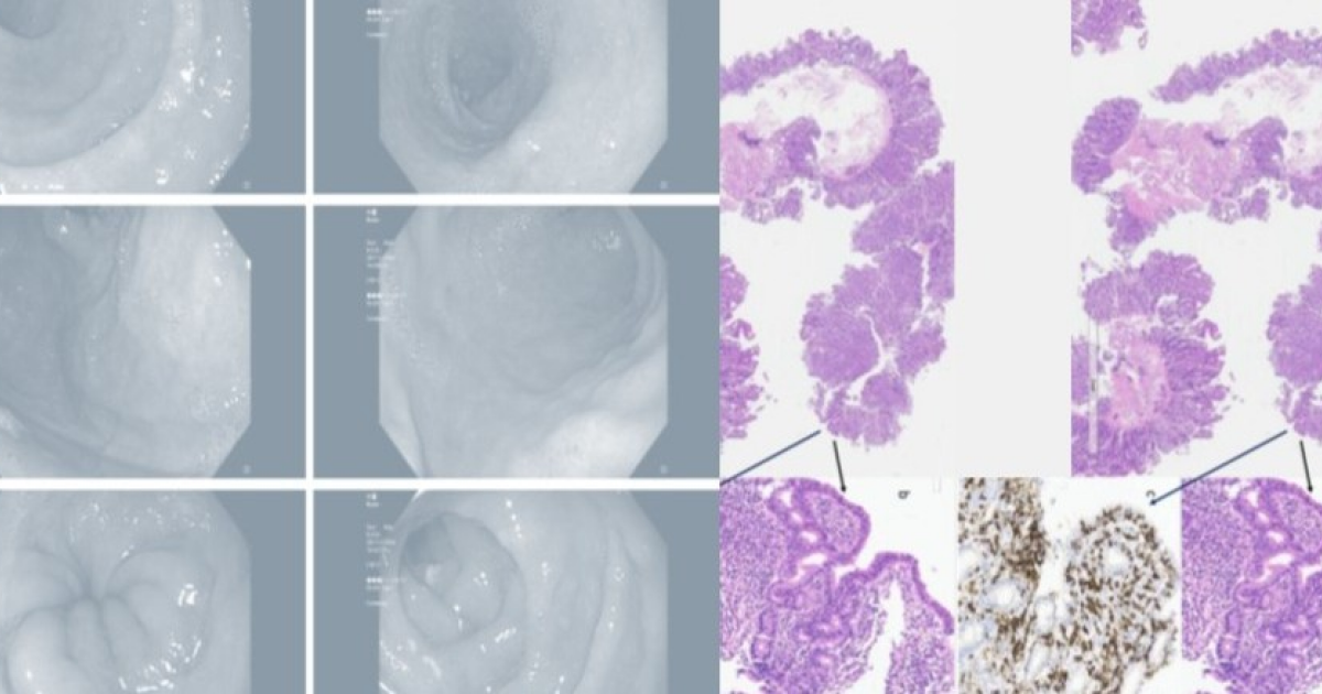Лекарство от давления вызвало энтеропатию и диарею у пожилой итальянки