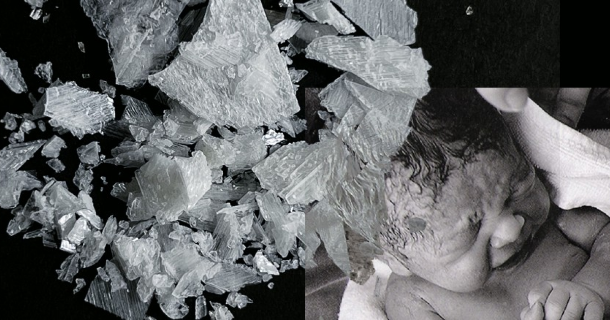 Парацетамол не повысил выживаемость у недоношенных детей с открытым артериальным протоком