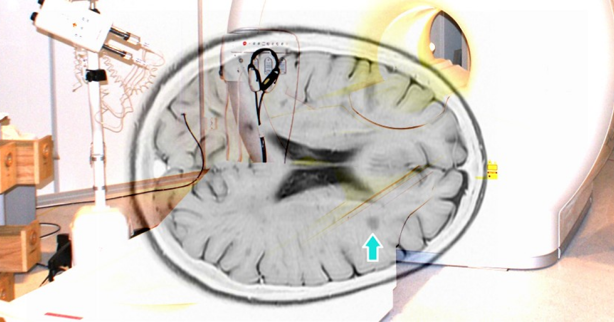Пятилетний прием ублитуксимаба снизил число рецидивов рассеянного склероза