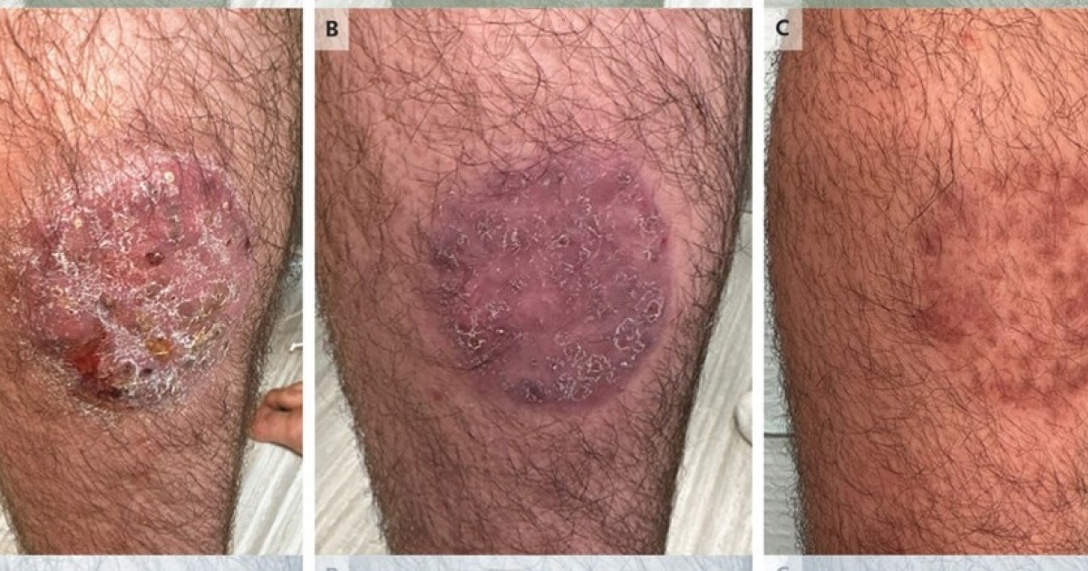 Семнадцатилетний американец заработал гранулему Майокки на борьбе