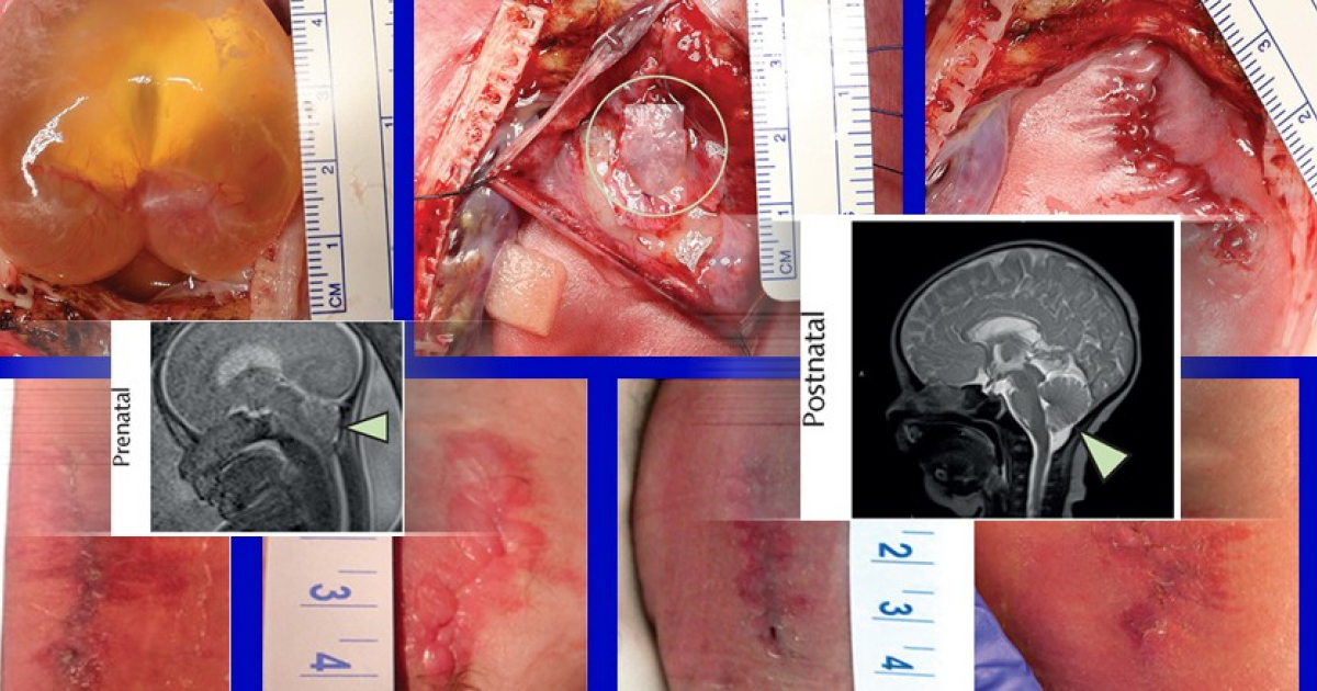 Внутриутробная стволовая терапия помогла при расщеплении позвоночника
