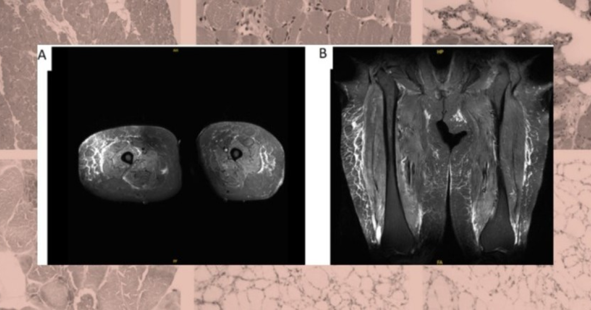 Семаглутид вызвал иммуноопосредованное разрушение мышц у пожилой американки