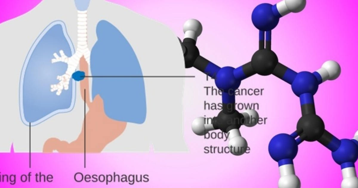 Метформин снизил риск развития рака пищевода