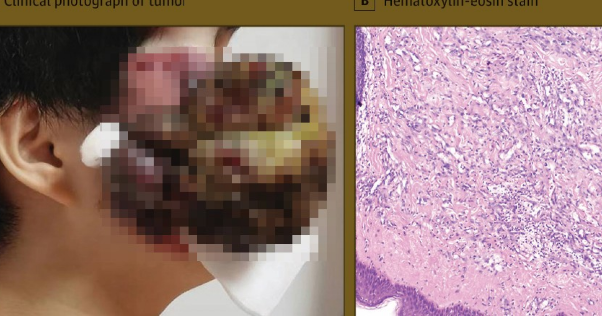 Ковид спровоцировал рост огромной сосудистой опухоли на лице китаянки