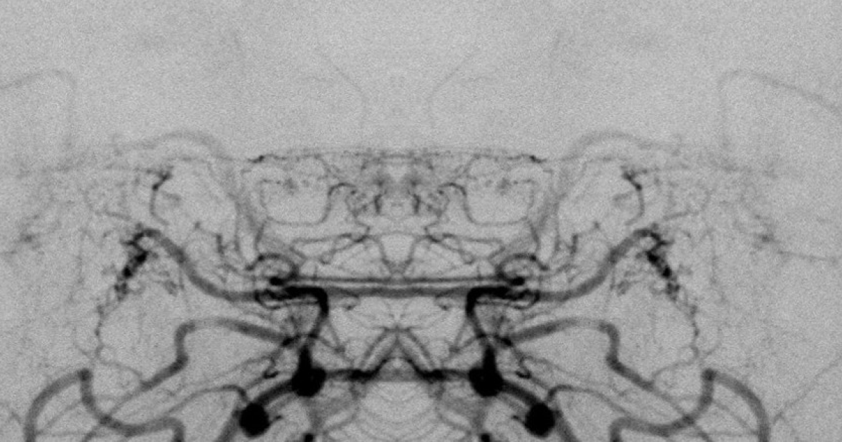 Способ родов не повлиял на риск инсульта у женщин с болезнью моямоя