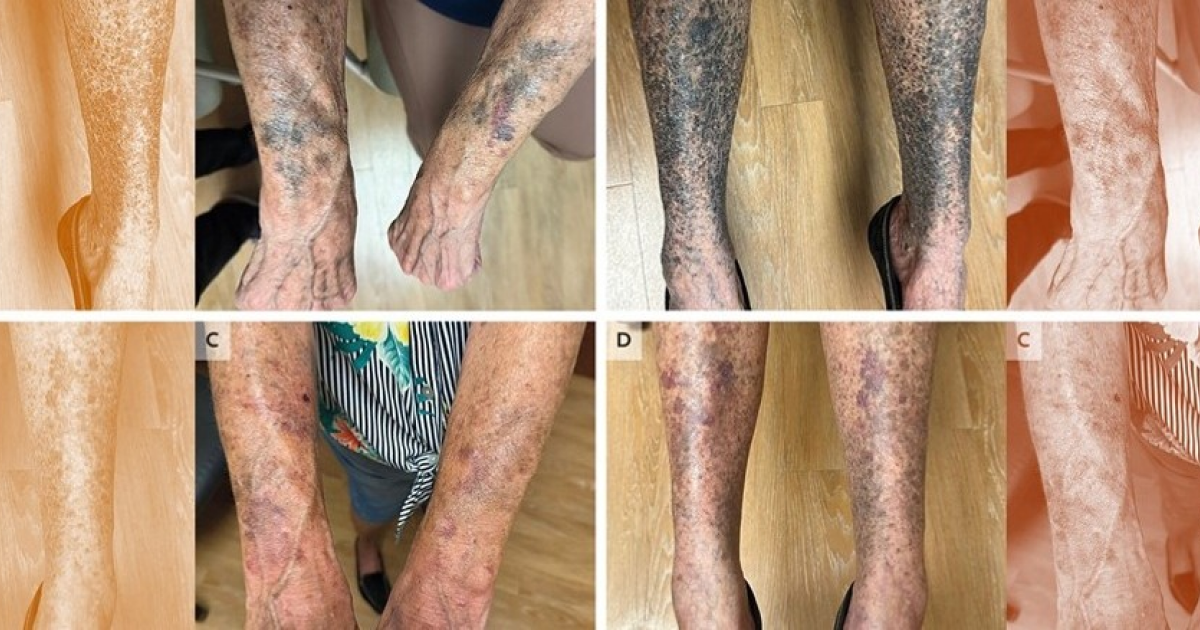 Потемнение кожи на руках и ногах пожилой американки объяснили действием миноциклина