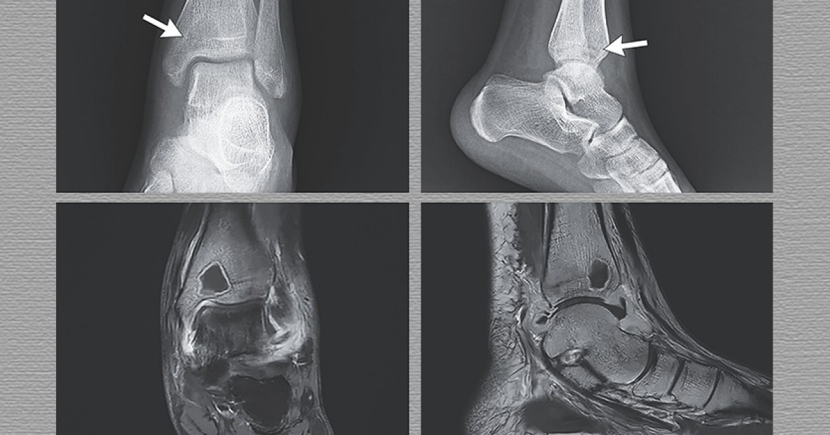 Сальмонелла вызвала у китаянки абсцесс кости