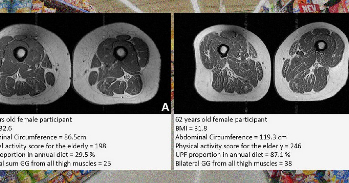 Употребление ультраобработанной пищи связали с повышенной жировой инфильтрацией мышц