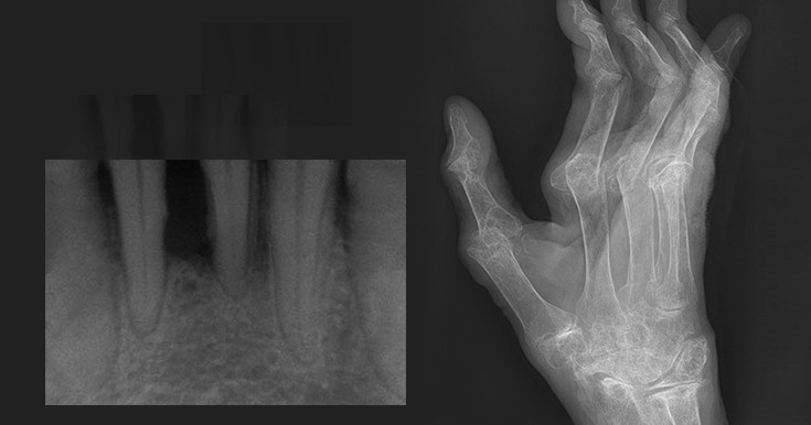 Бактерии из воспаленных десен проникли в кровь и усугубили ревматоидный ...