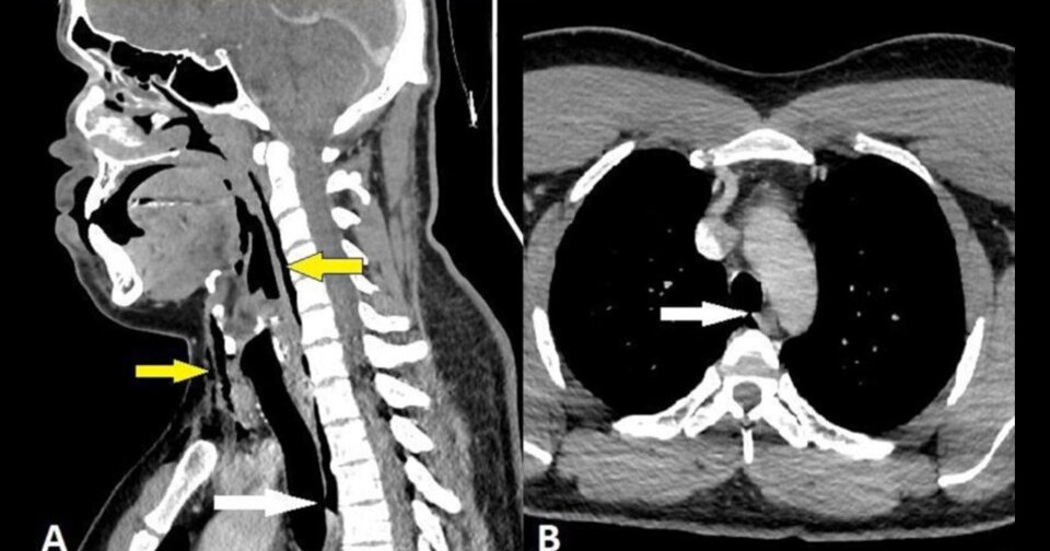 Сдержанный чих привел к разрыву трахеи у молодого британца. Однако ...