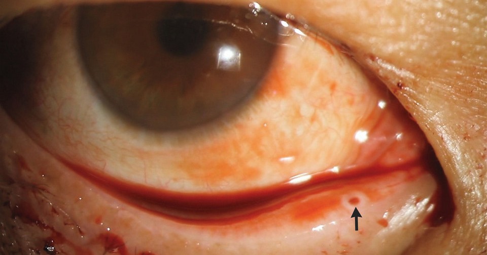 К китайским врачам обратился пациент с кровью из глаз. Она поступала из ...